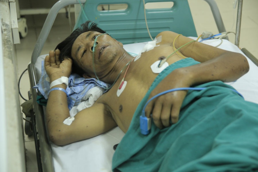 Những hình ảnh gây sốc về bệnh liên cầu lợn - 6 Nhiều bệnh nhân chịu di chứng suốt đời do phải tháo bỏ khớp vì hoại tử các đầu chi do liên cầu lợn.