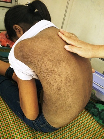 Cô học trò 13 năm không bạn vì mắc bệnh kỳ lạ - 2 Trên người em đầy những vết nứt nẻ, nhiều nốt nhỏ li ti