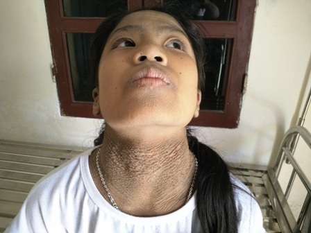 Cô học trò 13 năm không bạn vì mắc bệnh kỳ lạ - 3 Trên cổ da sần sùi, nứt nẻ nhìn rất đang sợ