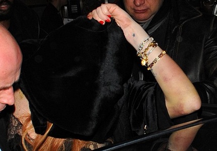 Lindsay để lộ đôi tay đầy vết bầm tím.