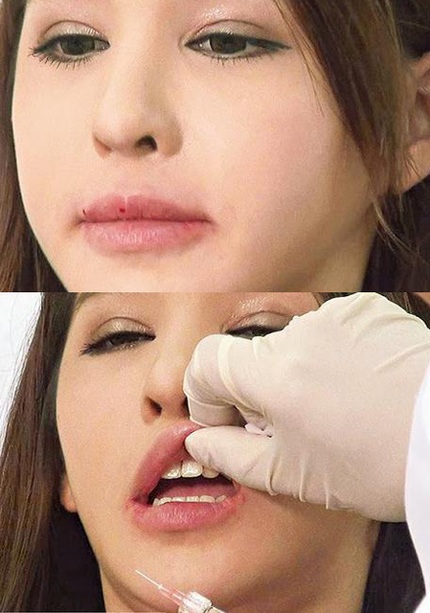Cận cảnh một ca bơm môi làm đẹp - 4 Vy Vy
