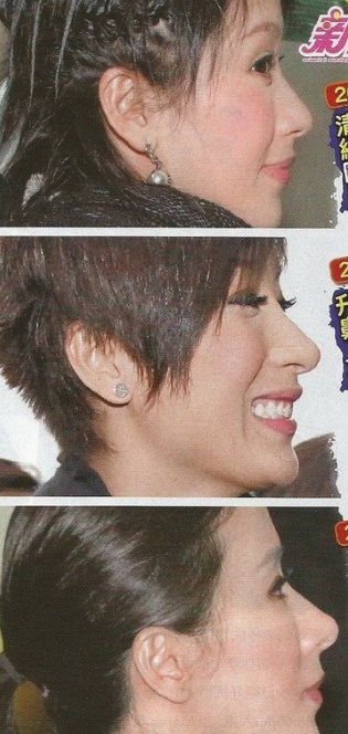 Ngôi sao Hồng Kông mặt méo mó vì phẫu thuật thẩm mỹ