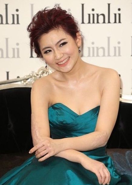 Hơn 3 năm sau vụ tai nạn, Selina đã bớt mặc cảm khi để lộ những vết sẹo trên cánh tay. 