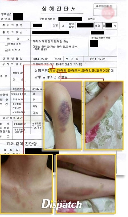 Bạn gái Kim Hyun Joong tung ảnh chứng minh bị hành hung - 2 Kim Hyun Joong đang mất điểm trong mắt người hâm mộ vì scandal hành hung bạn gái.