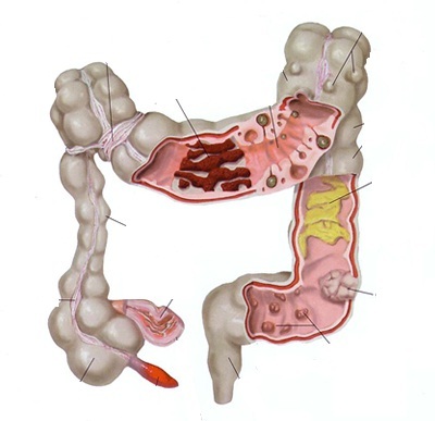 Bệnh nhân viêm đại tràng... "rùng mình" vì thực phẩm nhiễm bẩn! - 1