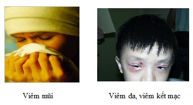 Dễ “mắc” như… dị ứng - 1 Dễ “mắc” như… dị ứng - 1
