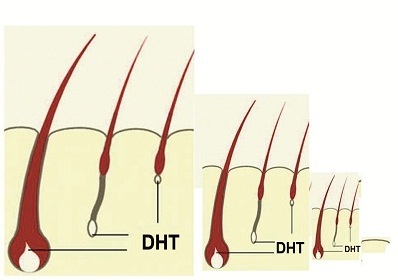 DHT - "Thủ phạm giấu mặt" của chứng rụng tóc, hói đầu! - 2 DHT - "Thủ phạm giấu mặt" của chứng rụng tóc, hói đầu! - 2