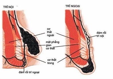 Tái mắc trĩ sau phẫu thuật - 1