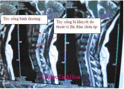 Đau vai gáy - căn bệnh không nên chủ quan - 2 Đau vai gáy - căn bệnh không nên chủ quan - 2