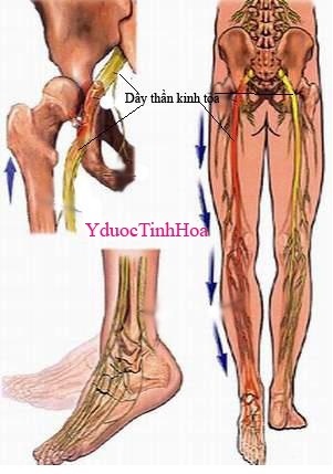 Thần kinh tọa và thoát vị đĩa đệm - 2