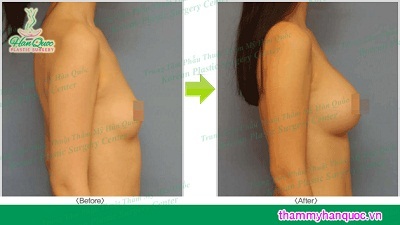 Nâng ngực nội soi công nghệ mới từ Thẩm mỹ Hàn Quốc - 1 Nâng ngực nội soi công nghệ mới từ Thẩm mỹ Hàn Quốc - 1