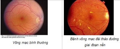 Bệnh võng mạc đái tháo đường - 1 Bệnh võng mạc đái tháo đường - 1