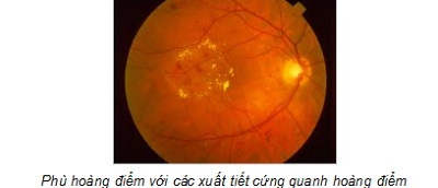 Bệnh võng mạc đái tháo đường - 2 Bệnh võng mạc đái tháo đường - 2
