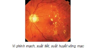 Bệnh võng mạc đái tháo đường - 3 Bệnh võng mạc đái tháo đường - 3