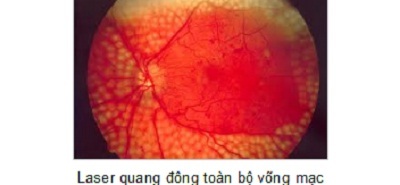 Bệnh võng mạc đái tháo đường - 5 Bệnh võng mạc đái tháo đường - 5