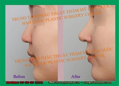 Nâng mũi S line kỹ thuật nâng mũi mới nhất từ Thẩm Mỹ Hàn Quốc - 2 Nâng mũi S line kỹ thuật nâng mũi mới nhất từ Thẩm Mỹ Hàn Quốc