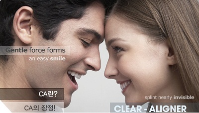 Niềng răng không mắc cài - 2 Niềng răng không mắc cài
