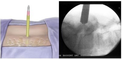 3 cách phẫu thuật cột sống ít xâm lấn - 1 3 cách phẫu thuật cột sống ít xâm lấn
