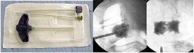 3 cách phẫu thuật cột sống ít xâm lấn - 3 3 cách phẫu thuật cột sống ít xâm lấn