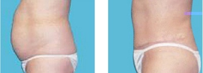 Giảm mỡ bụng cho cả nam và nữ - 2 Giảm mỡ bụng cho cả nam và nữ
