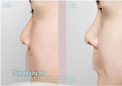 Nâng mũi S line tại thẩm mỹ Hàn Quốc JW - 5 Xem thêm thông tin tại