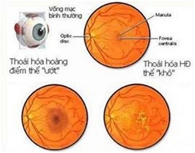 Geego Sure đẩy lùi bệnh thoái hóa hoàng điểm mắt ở người cao tuổi