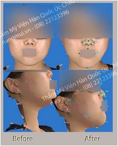Phẫu thuật khuôn mặt 3D tại thẩm mỹ Úc Châu - 3 Máy chụp hình tái tạo khuôn mặt 3 chiều trong không gian cho khách hàng xem hình mô phỏng