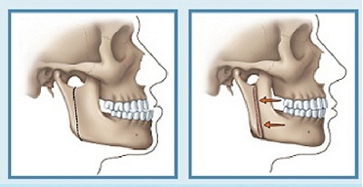 Chỉnh hình răng hô bằng phẫu thuật - 2 Quy trình cắt xương hàm chỉnh hô thực hiện như thế nào?