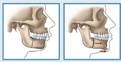 Chỉnh hình răng hô bằng phẫu thuật - 3 Quy trình cắt xương hàm chỉnh hô thực hiện như thế nào?