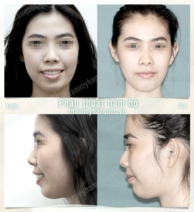 Chỉnh hình răng hô bằng phẫu thuật - 5 Quy trình cắt xương hàm chỉnh hô thực hiện như thế nào?