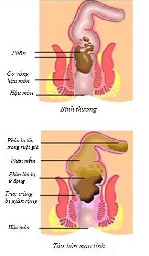Giải pháp an toàn, giải quyết tận gốc vấn đề táo bón