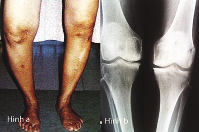 Collagen type II không biến tính: Liệu pháp mới trong điều trị thoái hóa khớp - 1 Hình ảnh một trường hợp thoái hóa khớp gối nhìn từ ngoài và trên X-quang.