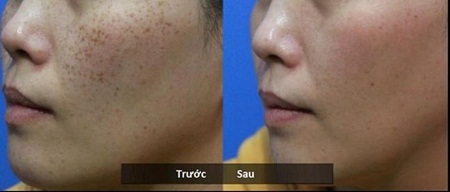 Spectra – bước đột phá trong công nghệ điều trị nám da - 5 Sự khác biệt rõ ràng ngay sau lần điều trị đầu tiên