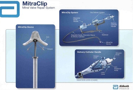 Niềm hy vọng cho người mắc bệnh hở van tim 2 lá - 1 Toàn bộ hệ thống MitraClip của Abbott Vascular