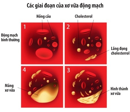 Vì sao người gầy vẫn bị rối loạn mỡ máu, cao huyết áp? - 1 Vì sao người gầy vẫn bị rối loạn mỡ máu, cao huyết áp?