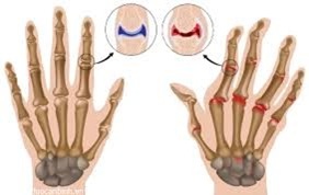 Nguyên nhân và giải pháp điều trị viêm khớp dạng thấp - 2 Nguyên nhân và giải pháp điều trị Viêm khớp dạng thấp