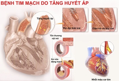 Những nguy cơ do hội chứng chuyển hóa - 2 Tăng huyết áp nguyên nhân chính dẫn đến suy tim
