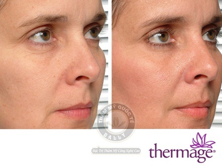 Đẹp hơn mỗi ngày nhờ công nghệ Thermage - 4 Trước và sau điều trị với Thermage