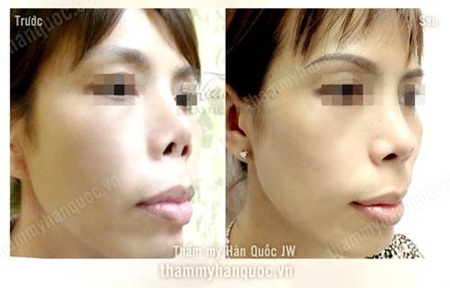 Phẫu thuật chỉnh hình mũi ngắn hếch chuyên nghiệp - 6 Hình ảnh phẫu thuật chỉnh hình mũi ngắn, hếch chuyên nghiệp tại Thẩm Mỹ Hàn Quốc JW: