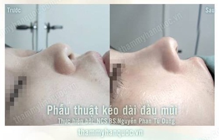 Phẫu thuật chỉnh hình mũi ngắn hếch chuyên nghiệp - 7 Sửa mũi ngắn hếch bẩm sinh