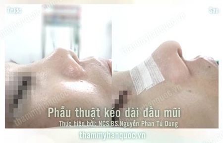 Phẫu thuật chỉnh hình mũi ngắn hếch chuyên nghiệp - 8 Sửa mũi ngắn hếch bẩm sinh