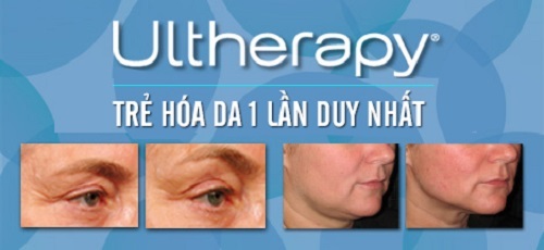 Khuyến mại cực sốc dịch vụ trẻ hóa da, nâng cơ Ultherapy - 5 Trước và sau trị liệu với Ultherapy