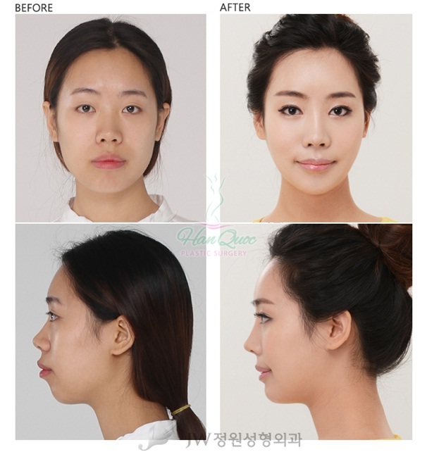 Thẩm mỹ khuôn mặt đẹp toàn diện tại Thẩm mỹ JW - 2 Xu hướng thẩm mỹ làm đẹp khuôn mặt hiện nay là gì?