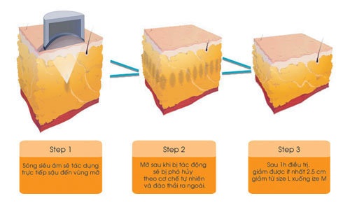 Công nghệ Liposonix giảm béo một lần duy nhất - 5 Các bước hoạt động của Liposonix.
