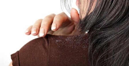 3 bước dứt điểm gàu dễ làm, hiệu quả - 2 Đội mũ bảo hiểm khi tóc ướt rất dễ gây nên các bệnh về da đầu