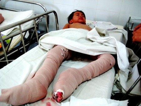 Cháu An hiện đang được điều trị tại Khoa Bỏng – tạo hình Bệnh viện Đà Nẵng
