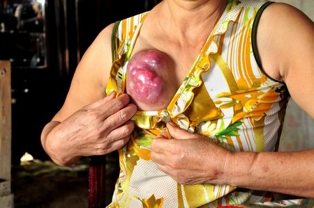 Khối u của bà Bông đã rất to, cần rất nhiều tiền để chữa trị