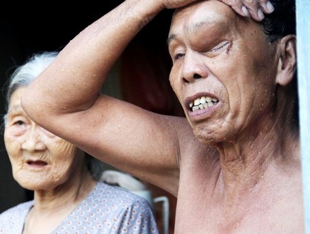 Ông Nguyễn Ghẹ với khối u giống như “chiếc sừng” trên đầu