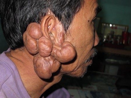 Những búi thịt kỳ dị quanh tai ông Dởn