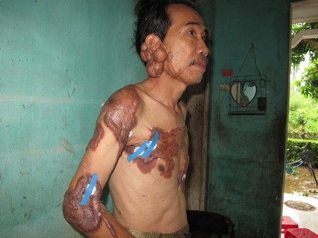 Những mảng sẹo lồi khiến ông Dởn đau nhức, cử động khó khăn